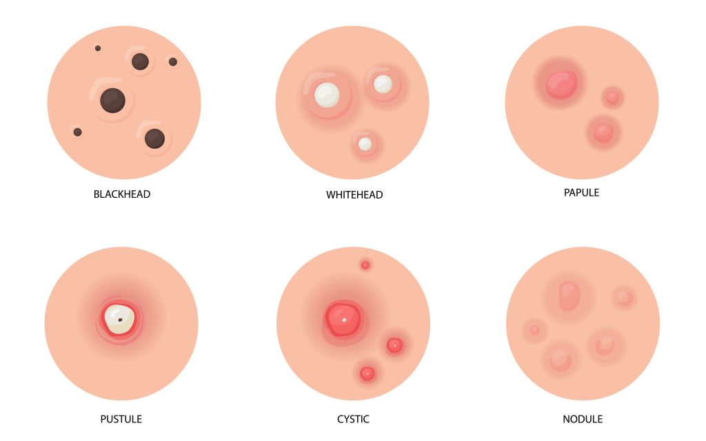 Different types of acne flat illustration